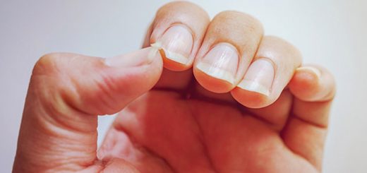 Striated nails: the causes and solutions to remedy it